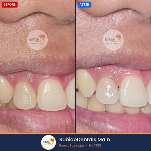 Before and after dental case