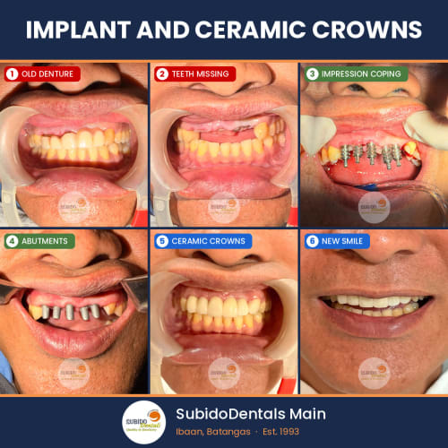 Before and after dental case
