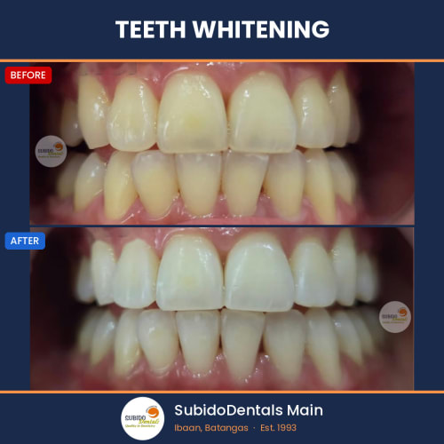 Before and after dental case