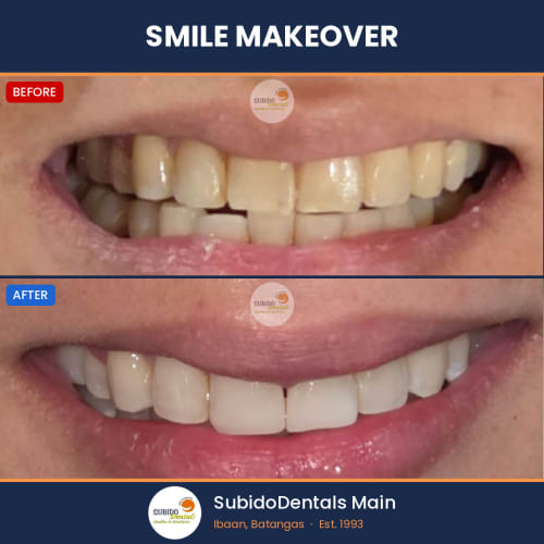 Before and after dental case