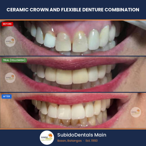 Before and after dental case