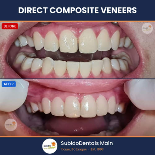 Before and after dental case