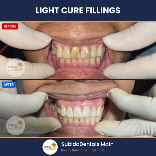 Before and after dental case