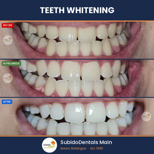 Before and after dental case