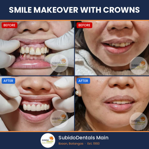Before and after dental case