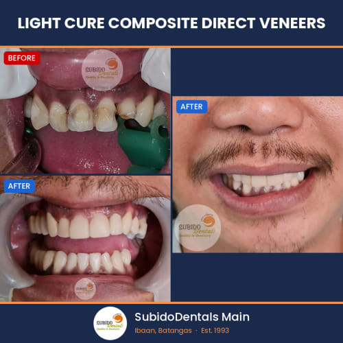 Before and after dental case