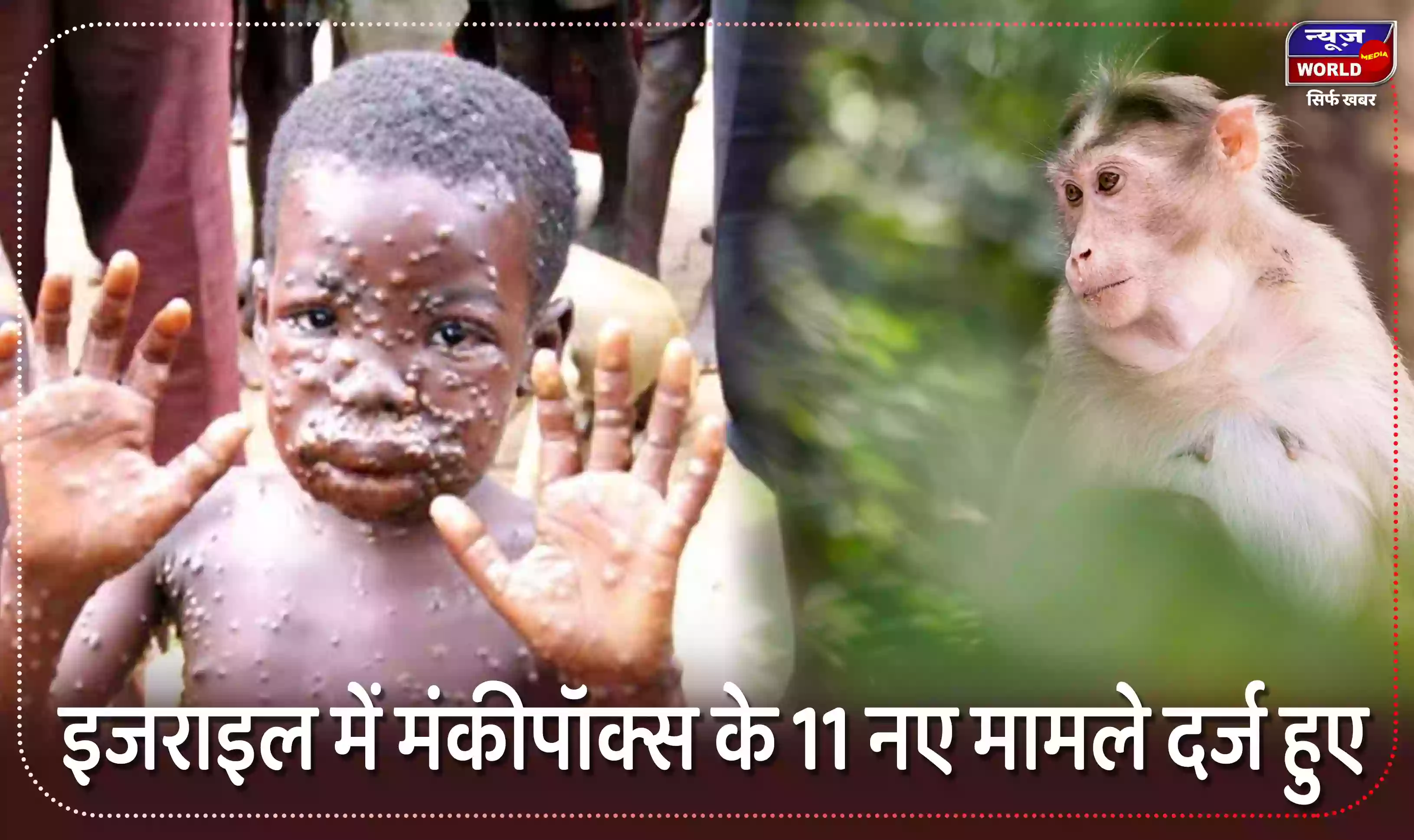 इजराइल में मंकीपॉक्स के 11 नए मामले दर्ज हुए, कुल आंकड़ा 66 तक पहुंचा