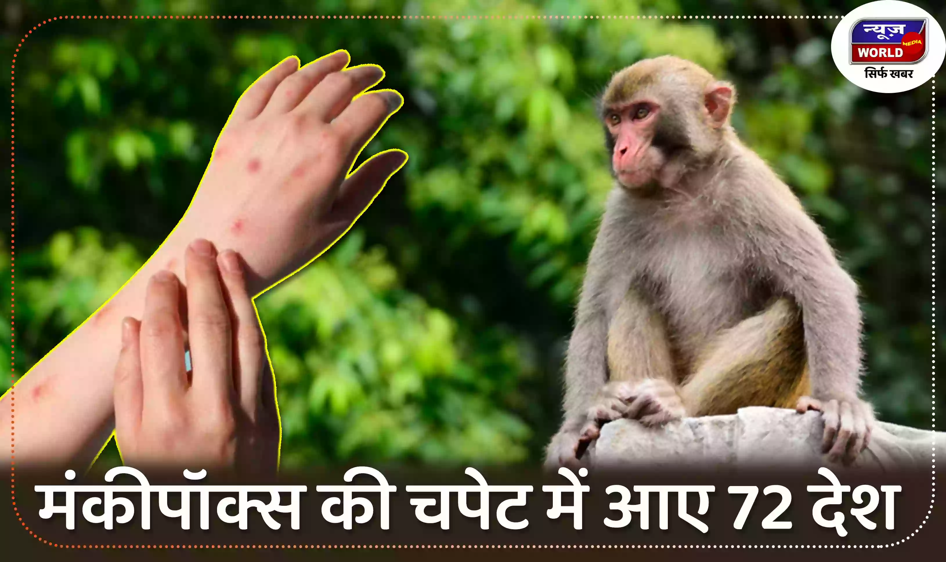 मंकीपॉक्स की चपेट में आए 72 देश, 15 हजार लोग हुए संक्रमित