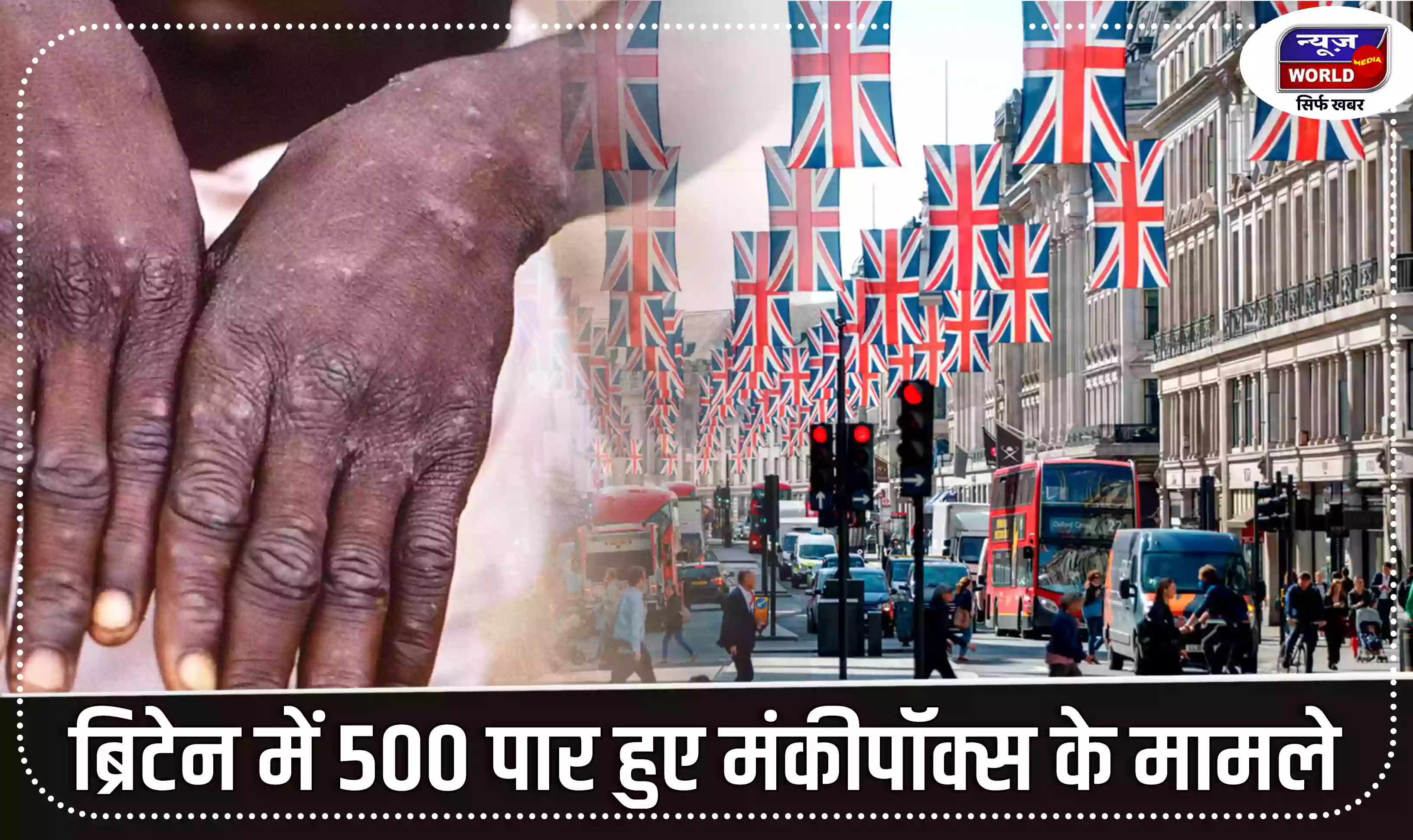 ब्रिटेन में 500 पार हुए मंकीपॉक्स के मामले, ज्यादातर मामले समलैंगिक और बायसेक्सुयल संबंध रखने वाले पुरुषों में आ रहे