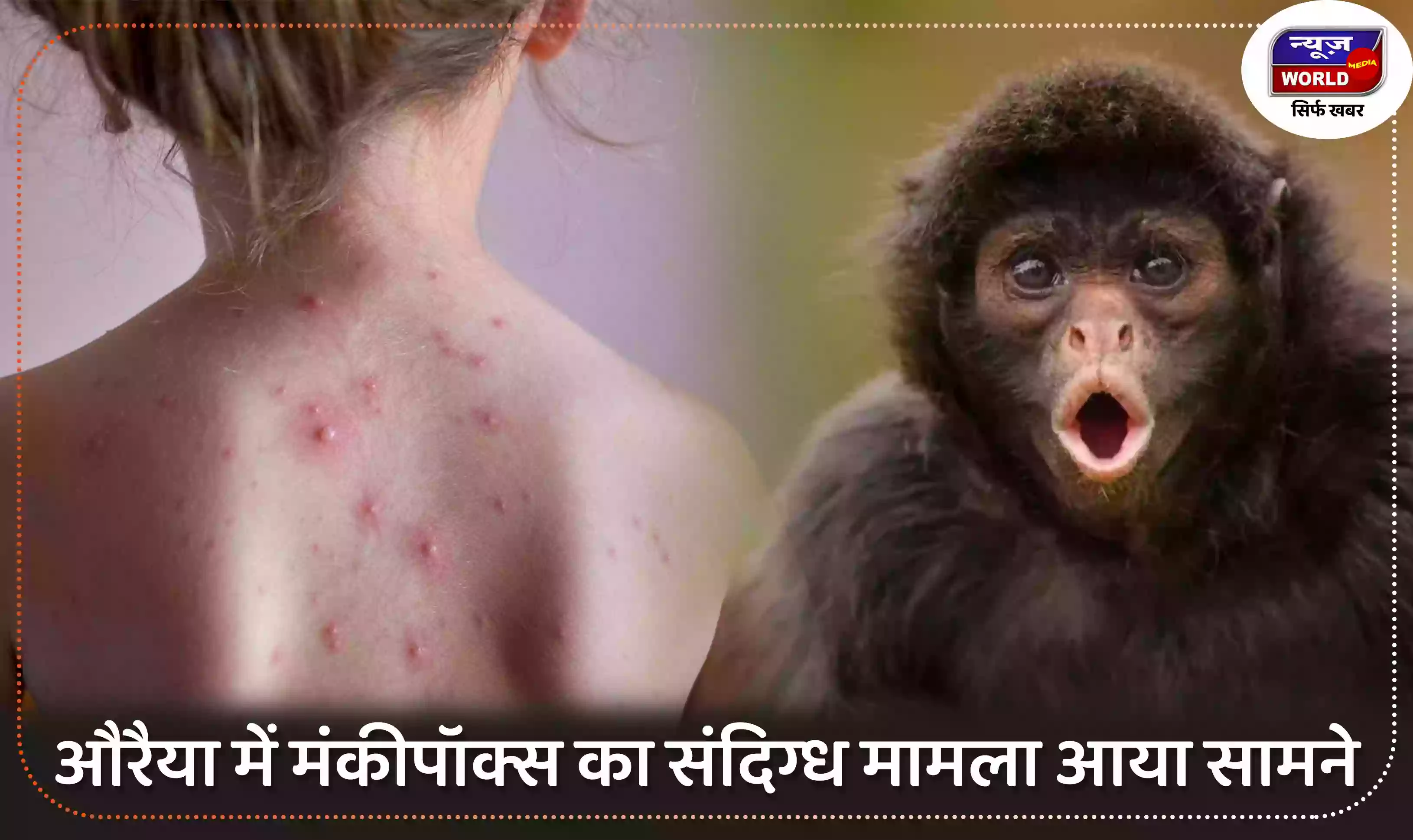 यूपी औरैया जिले में मंकीपॉक्स का संदिग्ध मामला आया सामने