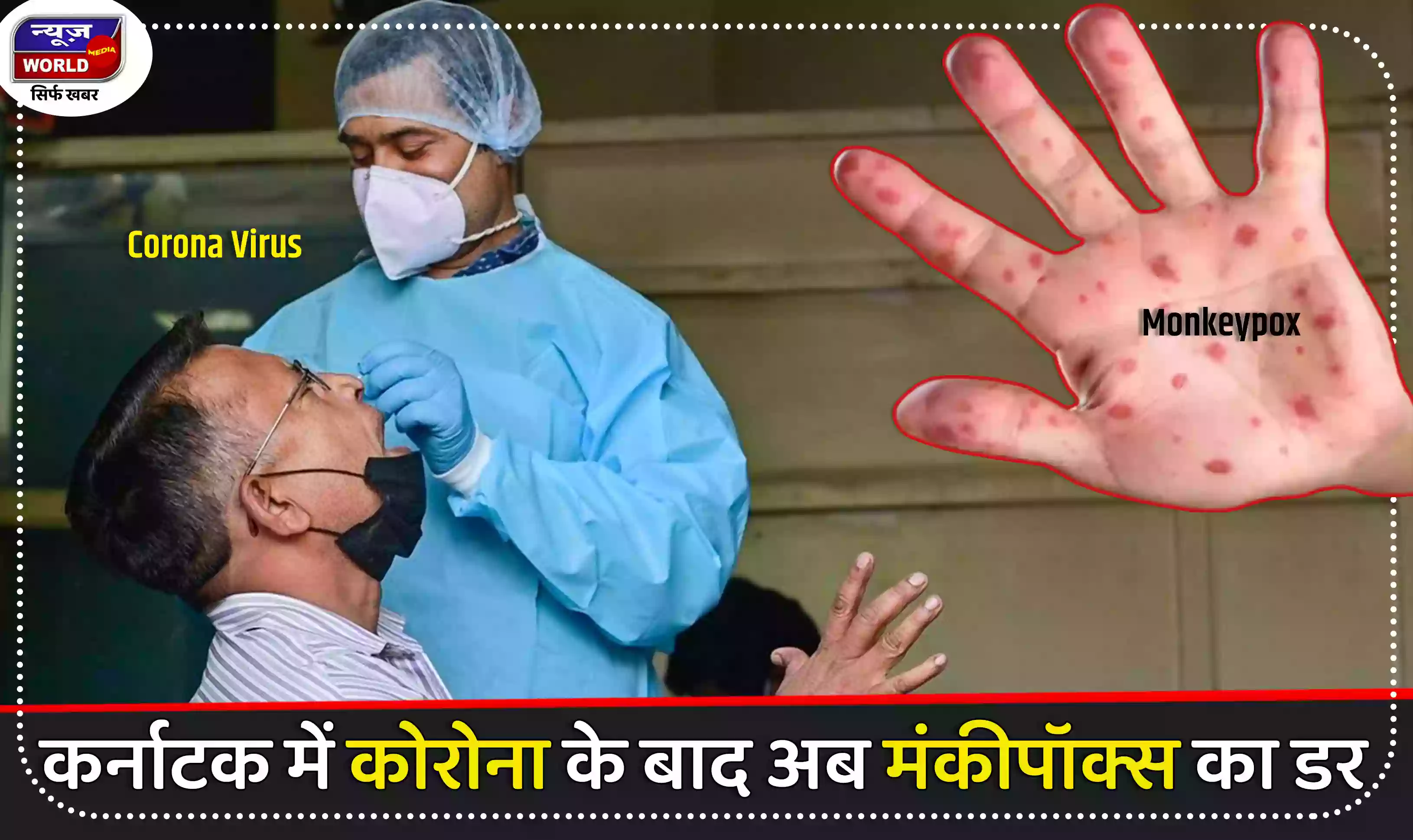 कर्नाटक में लोगों को कोरोना के बाद अब मंकीपॉक्स का डर सताने लगा है