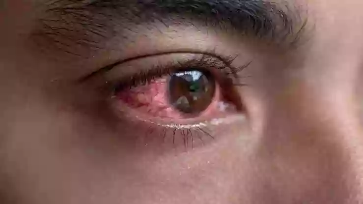 छत्तीसगढ़ में भी आई फ्लू ने पसारे पैर, प्रदेशभर में एक हफ्ते में मिले 19 हजार 155 मरीज, सरकार ने की समीक्षा बैठक