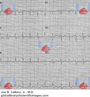 Suspected Atrial Flutter with Variable AV Conduction | Global Library ...