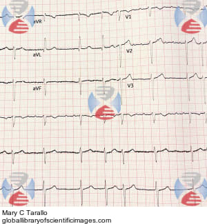 Atrial Flutter with Variable AV Conduction | Global Library of ...