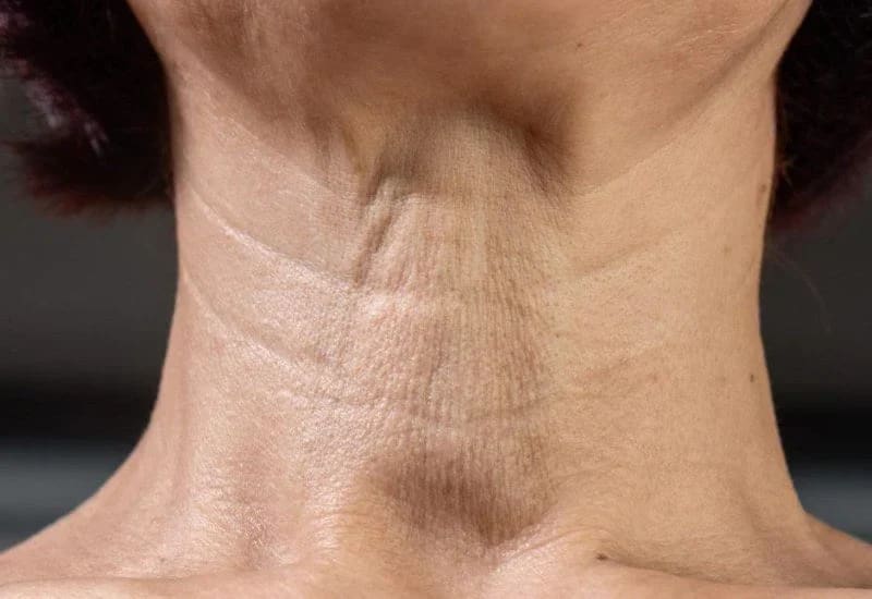Líneas del cuello