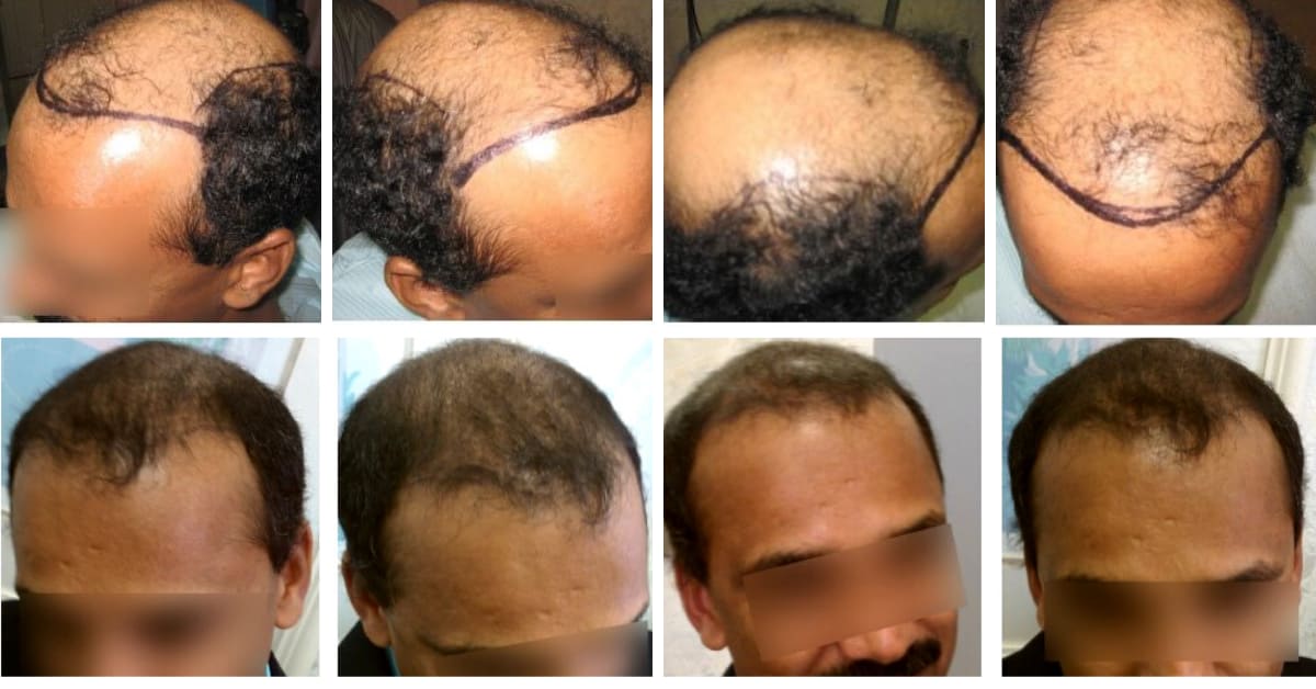 The Hairy Pill  Hair Loss Treatment  One Pill One Solution