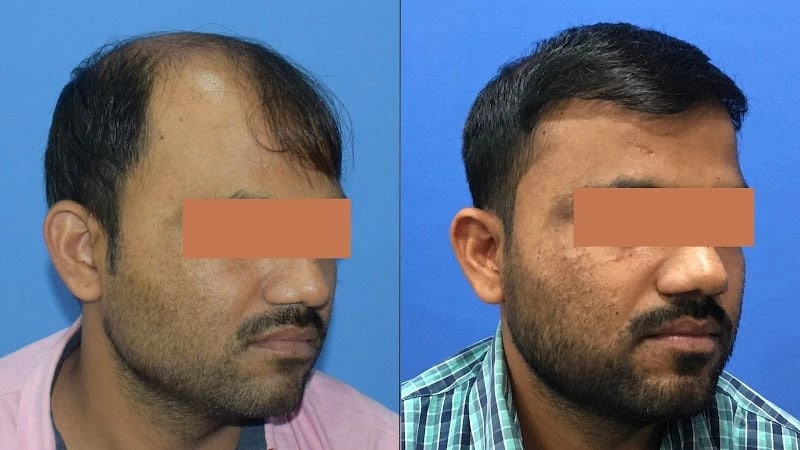 Best Hair Transplant Clinic Mumbai Best Hair Transplant Surgeon Mumbai  Dr Vaibhav Shah  Facial plastic Hair transplant Cosmetic surgery