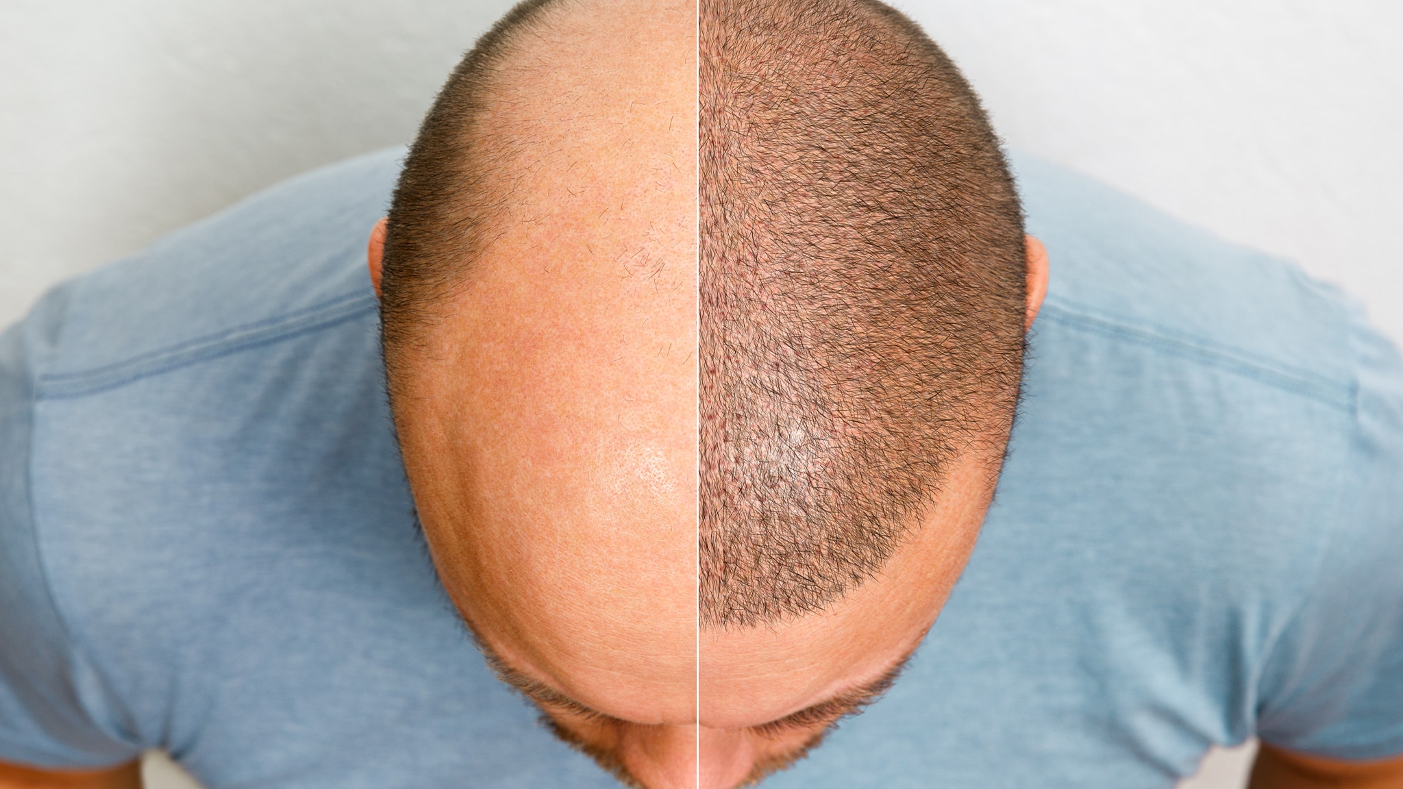 CAUSES OF HAIR LOSS IN DETAIL  HAIR TRANSPLANT IN NAVI MUMBAI