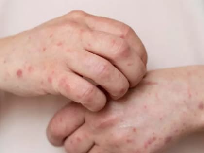 Еще один случай заболевания корью выявили в Тамбовской области