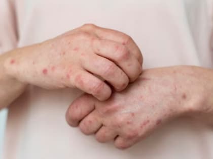 В Тамбовской области выявлен первый случай заболевания корью