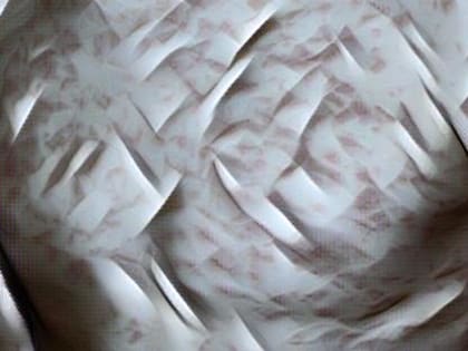 В Тамбовской области зафиксирован второй случай заболевания корью