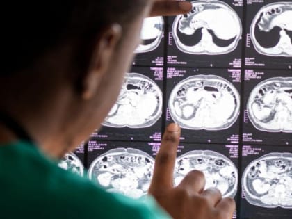 Инфекционист рассказал, как предупредить менингококковую инфекцию