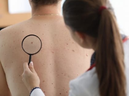 Дерматолог назвала самый опасный вид родинок