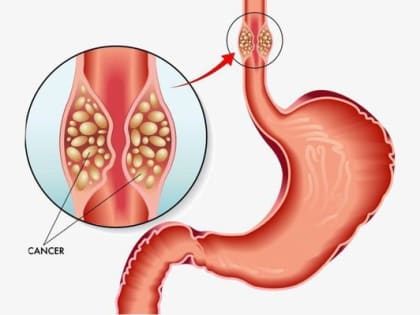 ГРЫЖА ПИЩЕВОДНОГО ОТВЕРСТИЯ ДИАФРАГМЫ – ОПАСНАЯ БОЛЕЗНЬ