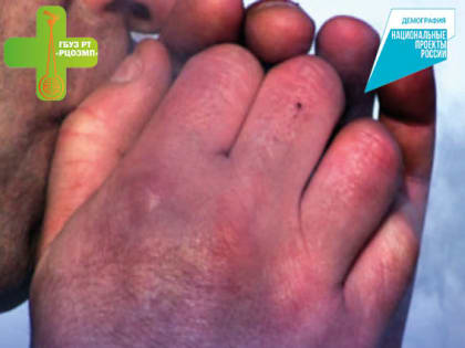 Первая помощь при обморожении