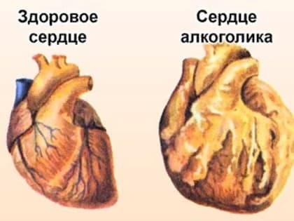 Влияние алкоголя для сердца