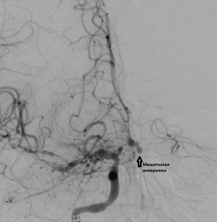 Аневризма головного мозга эндоваскулярным