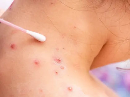 Вирусы ветрянки и герпеса: опасность на протяжении всей жизни