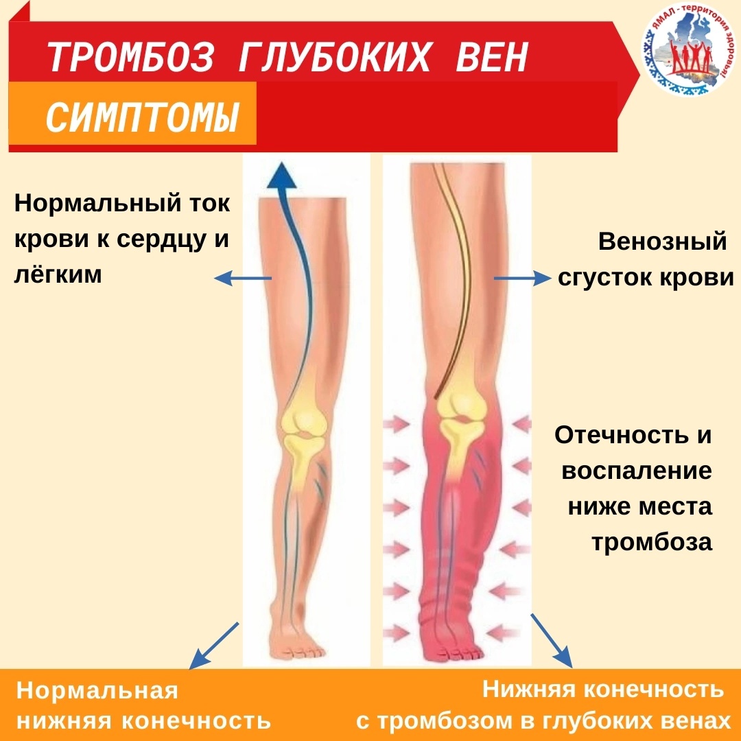 Наличие тромбов. Венозная тромбоэмболия. Тромбоз малоберцовых вен.