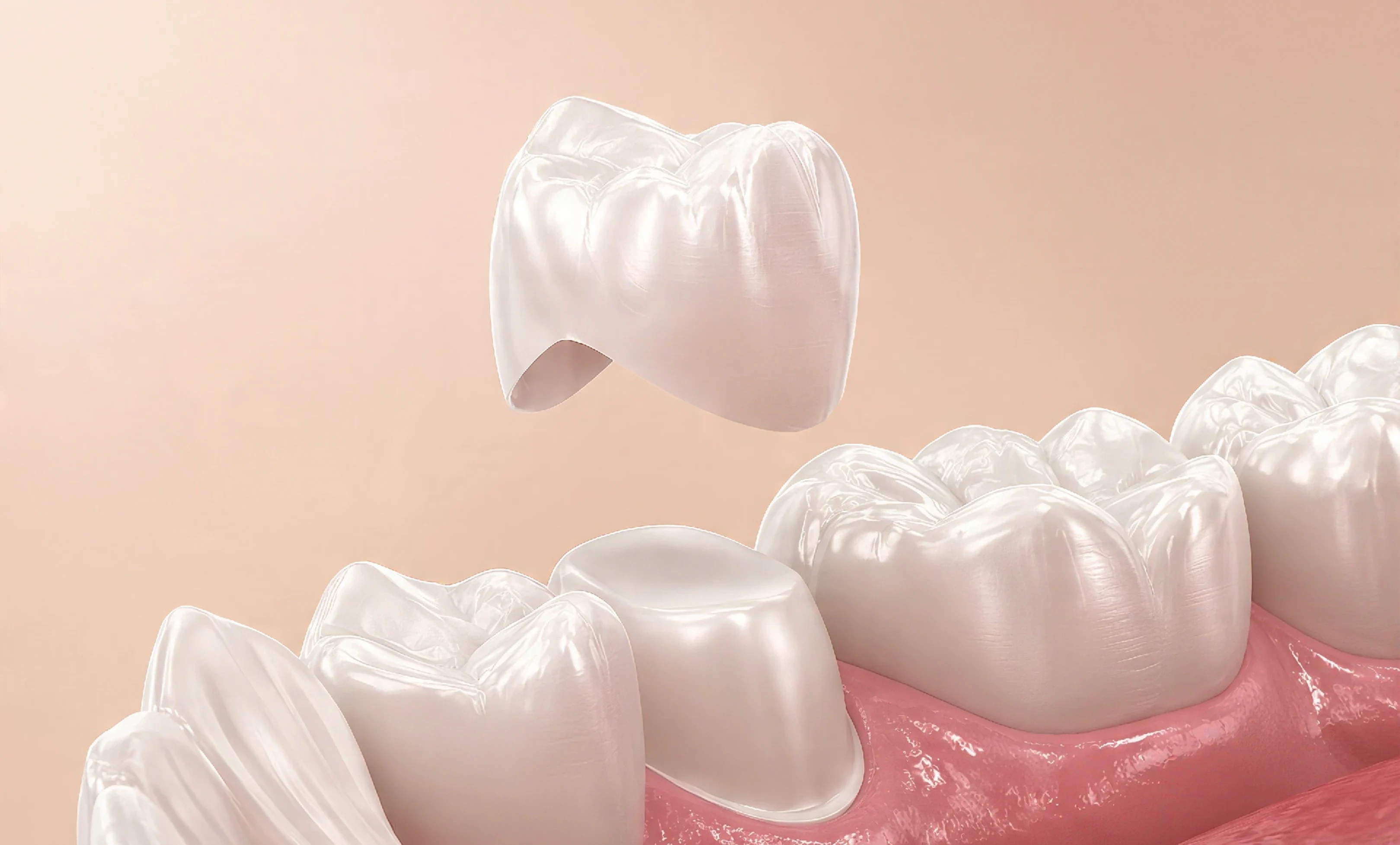 Porcelain Crowns.