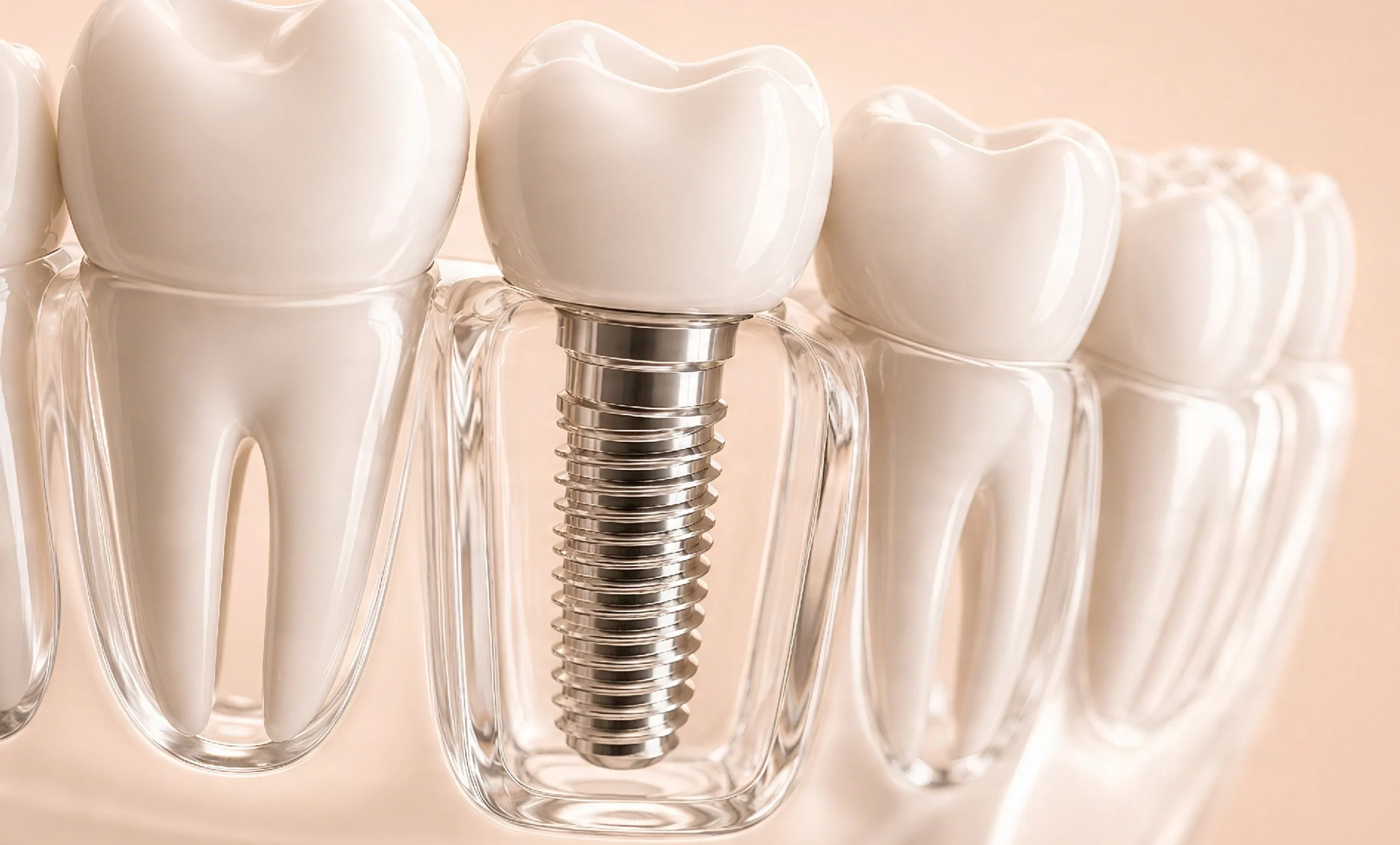 Implants.