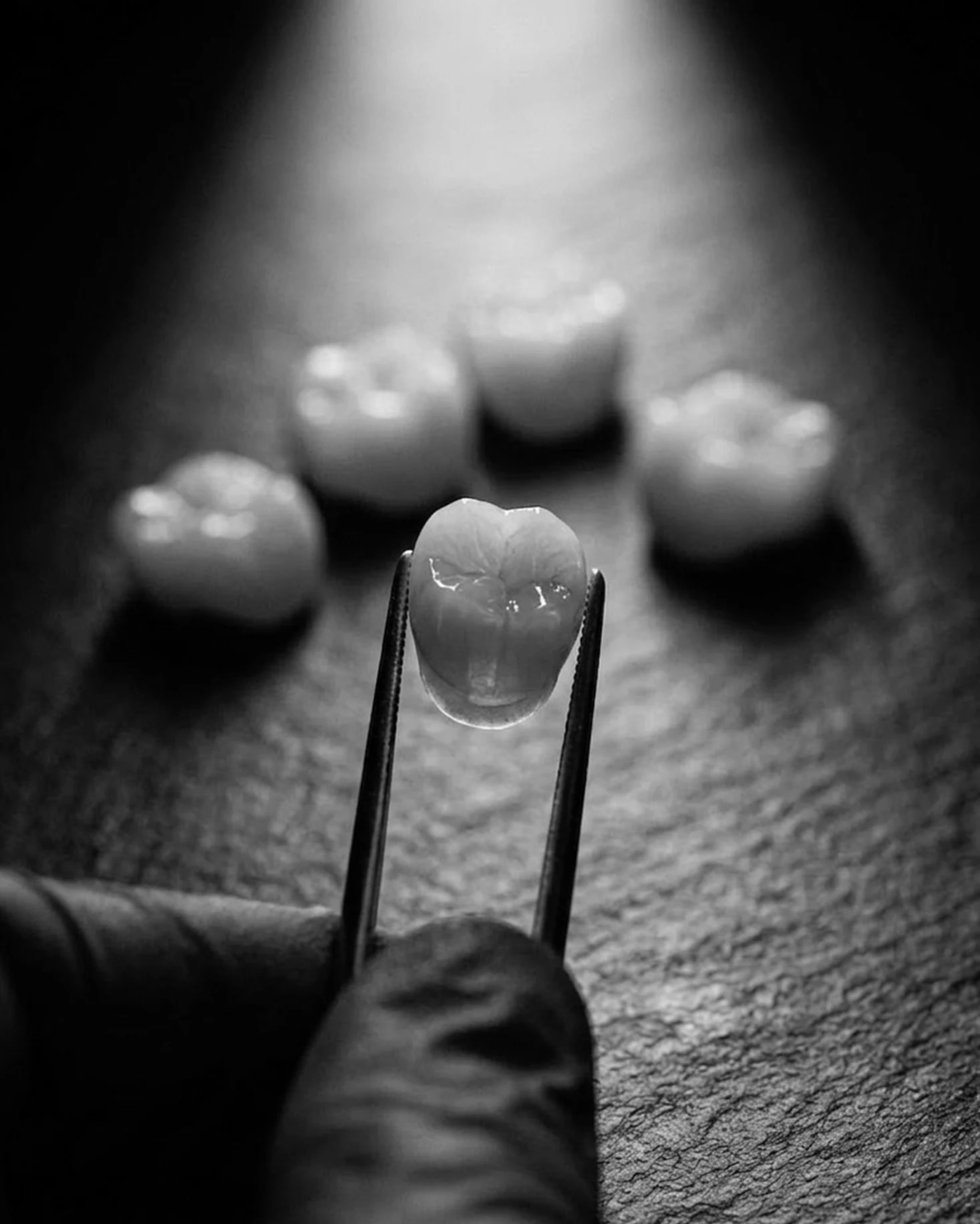 Crown vs Veneer