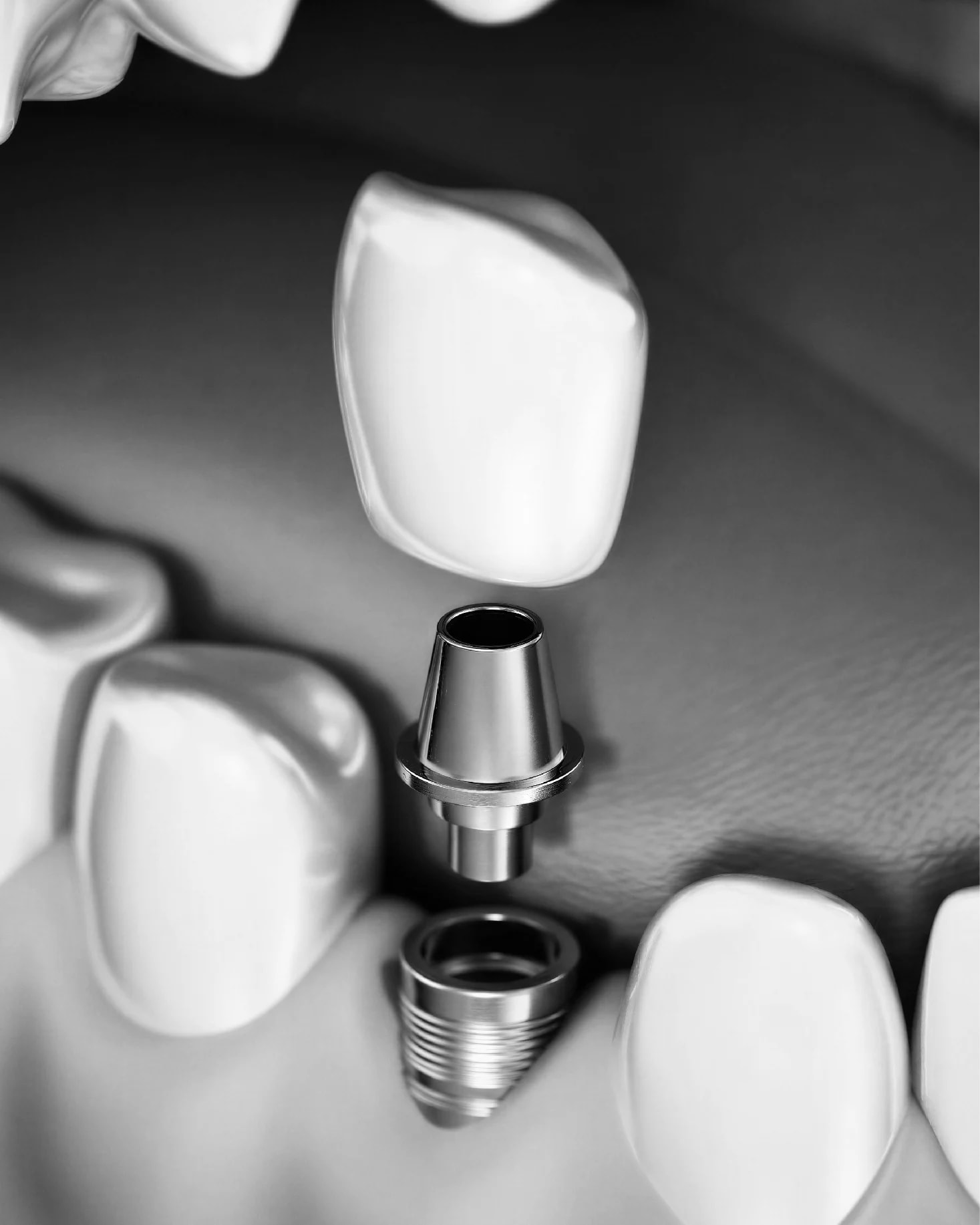 Implant Aftercare