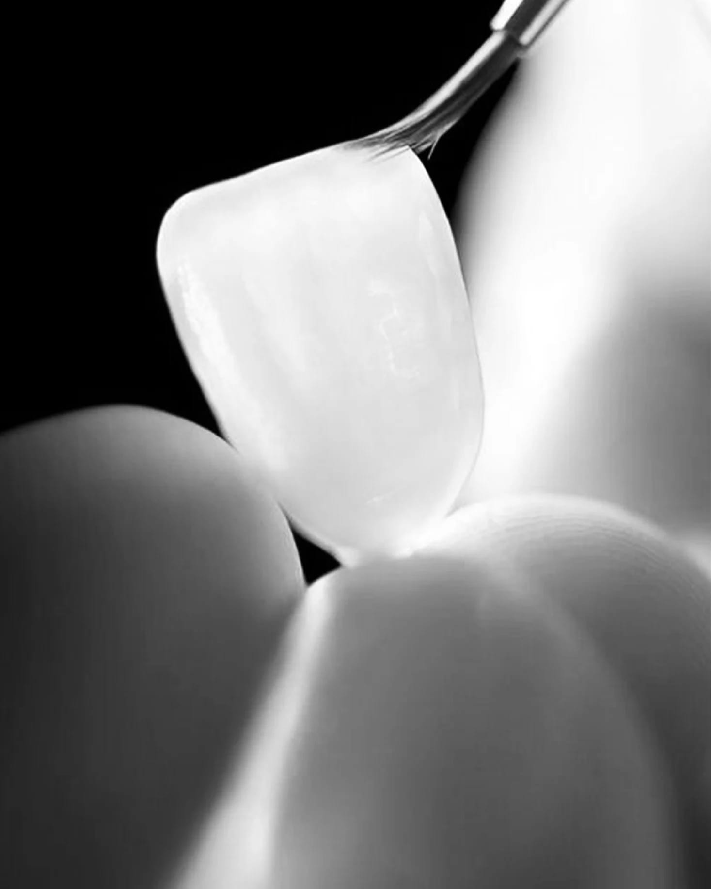 Veneer vs Crown