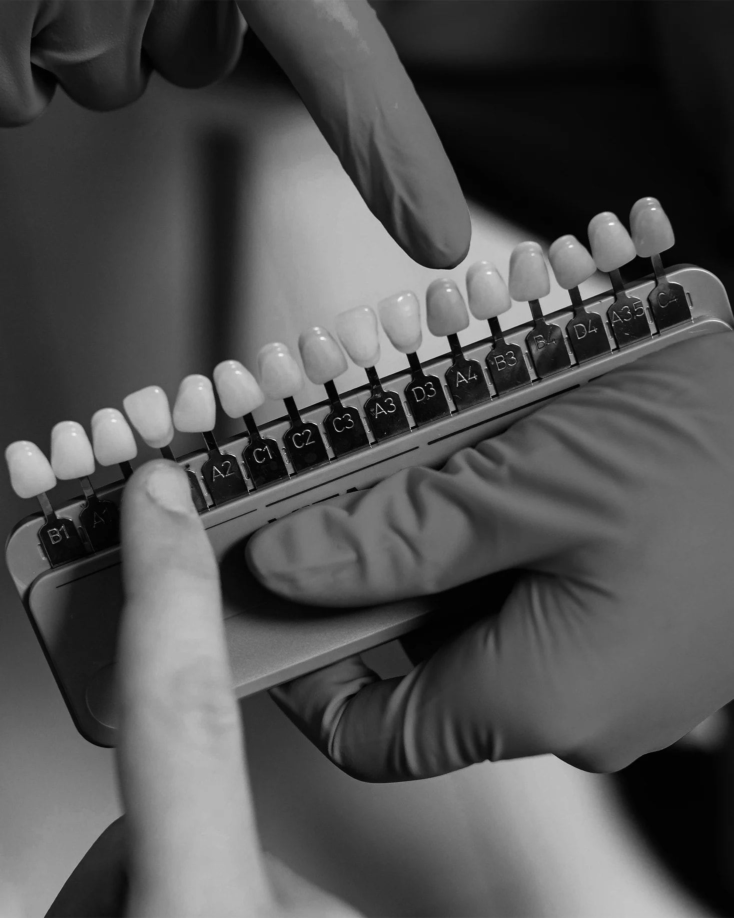 Veneer Aftercare