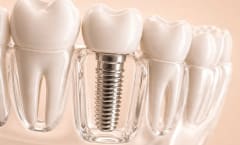 Dental Implants
