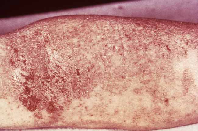 Dermatitis atopik. Sumber: anonim, PHIL CDC, 1975.