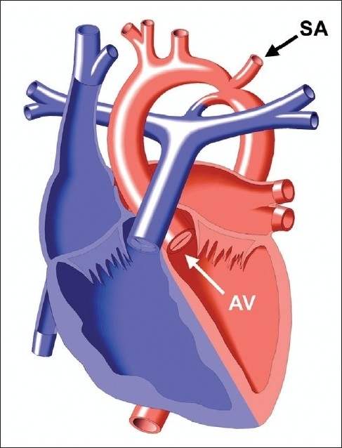 Koarktasio aorta. Sumber: anonim, Openi, 2011.