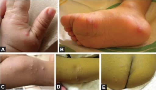 Gambaran klinis HFMD. Sumber: anonim, Openi, 2012.
