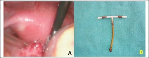 Menoragia akibat komplikasi IUD yang terdislokasi. Sumber: anonim, Openi, 2015.