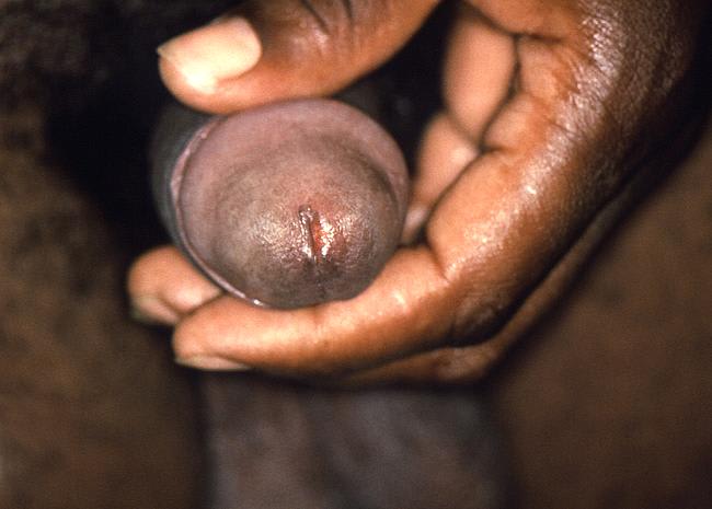 Uretritis. Sumber: J Pledger, PHIL CDC, 1979.