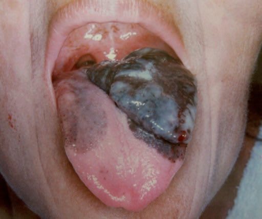 Melanoma pada lidah. Sumber: anonim, Openi, 2012.