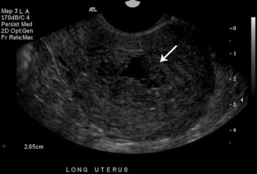 USG perdarahan uterus abnormal. Sumber: anonim, Openi, 2013.
