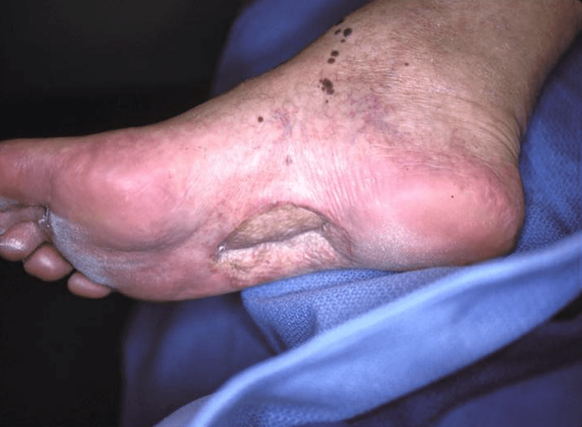 Acral lentiginous melanoma pada kaki kanan pasca operasi eksisi. Sumber: Carl Washington, Mona Saraiya, PHIL CDC, 2007.