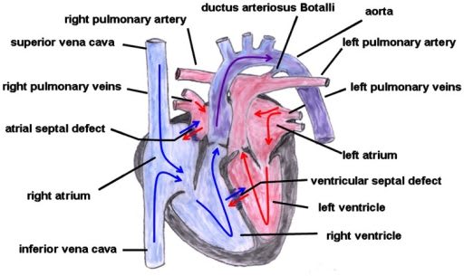 Transposisi arteri besar. Sumber: anonim, Openi, 2013.