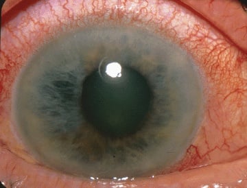 Glaukoma Sudut Tertutup Akut. Sumber: Jonathan Trobe, Wikimedia commons, 2011.